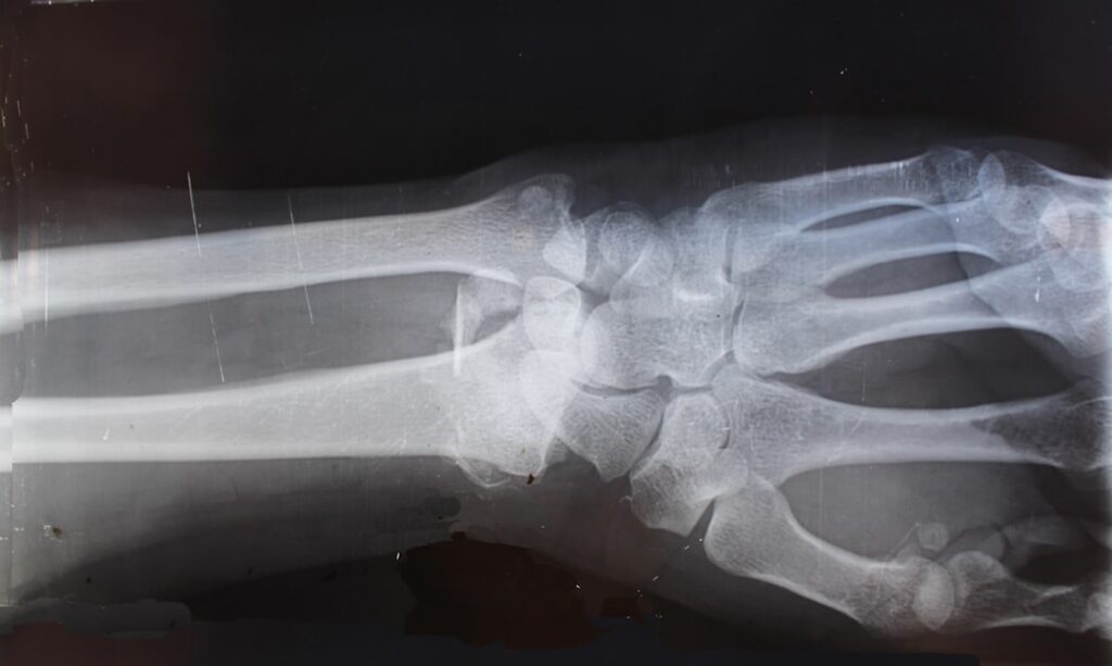 Radiografia per valorar una fractura després d'un accident