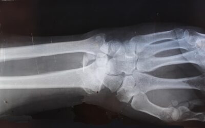 Fractures després d’un accident: seqüeles i indemnització
