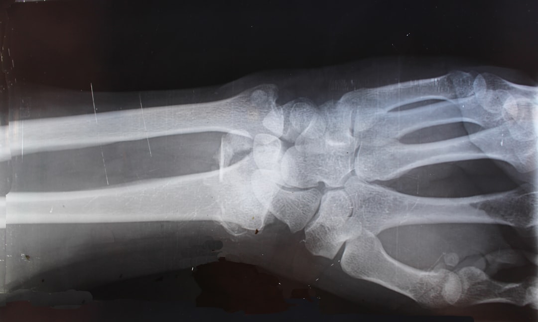 Radiografia per valorar una fractura després d'un accident